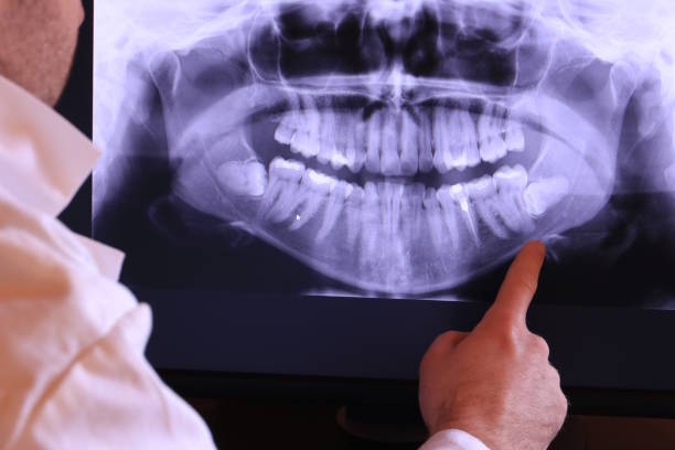 Best Emergency Dentist for Lost Fillings or Crowns in Cocoa West, FL