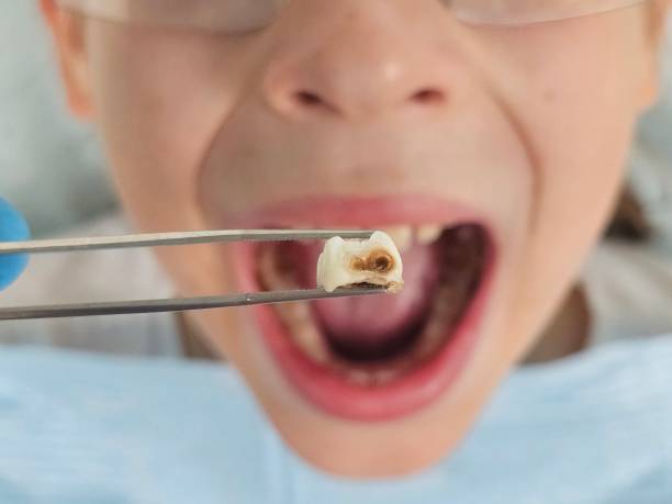 Best Emergency Dental Extractions in Cocoa West, FL